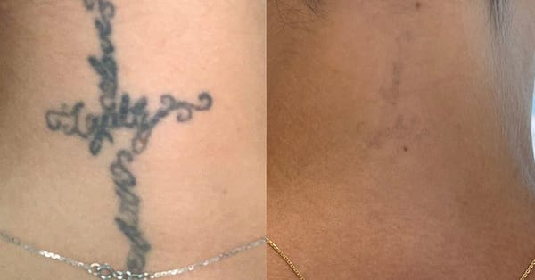 Three Sessions Of Laser Tattoo Removal: Small, Medium, Or Large Area Dubai - Image 3